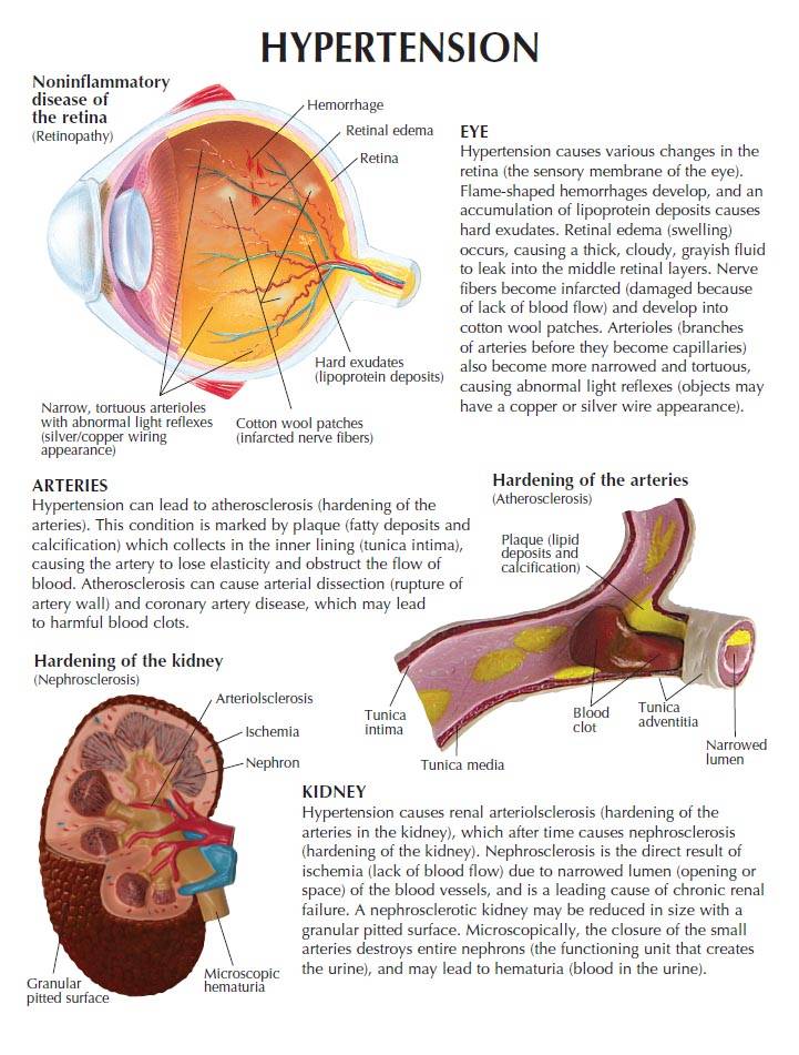 Gpi Hypertension Model Set