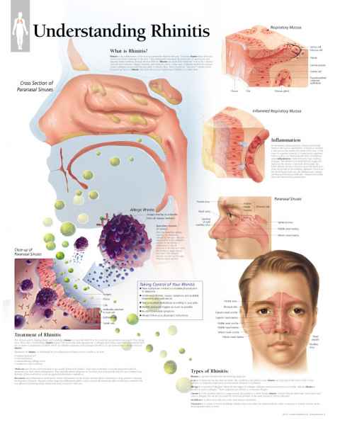 Understanding Rhinitis Chart