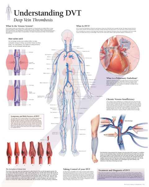 Understanding DVT (Deep Vein Thrombosis) Chart