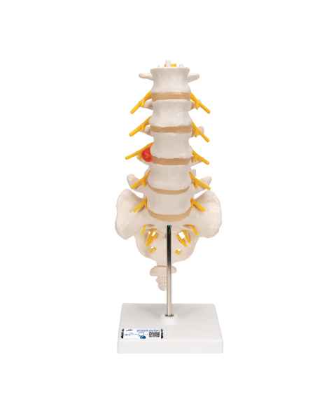 Flexible Lumbar Vertebral Column With Herniated Disc