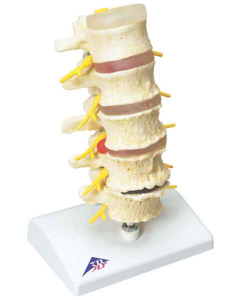 Stages of Disc Prolapse and Vertebral Degeneration