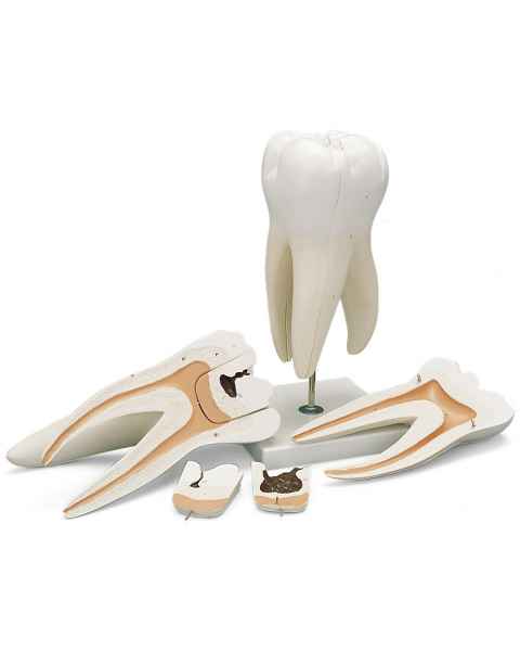 Giant Molar with Dental Cavities 5-Part - 15 Times Life-Size