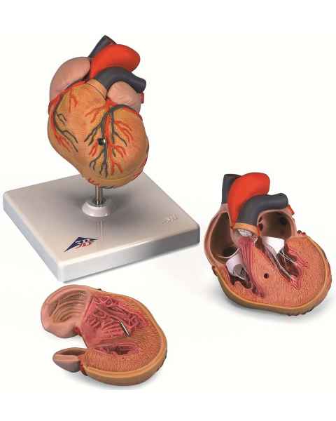 Classic Heart Model with Left Ventricular Hypertrophy (LVH) 2-Part