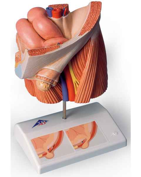 Inguinal Hernia Model