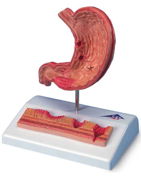 Stomach Model with Ulcers