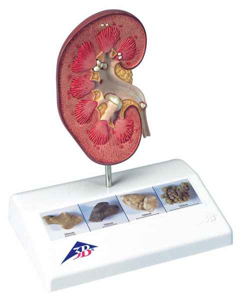 Kidney Stone Model