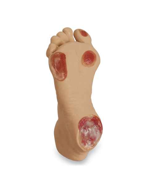 Life/form Elderly Pressure Ulcer Foot - Light