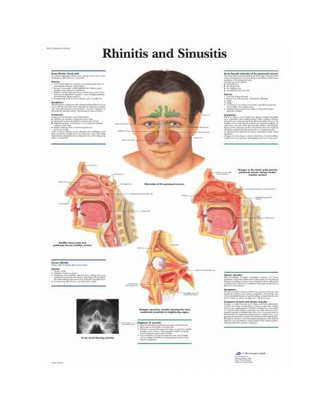 Rhinitis and Sinusitis Chart