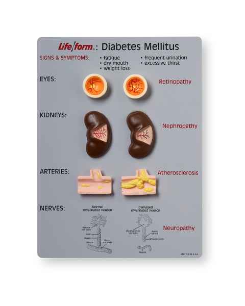 Life/form Diabetes Mellitus Teaching Kit