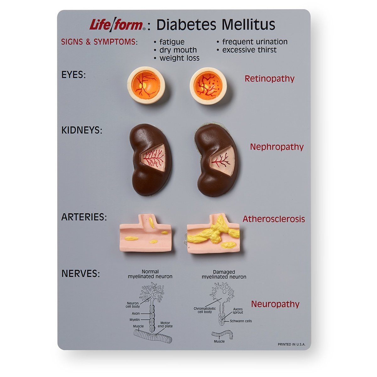 Life/form Diabetes Mellitus Teaching Kit