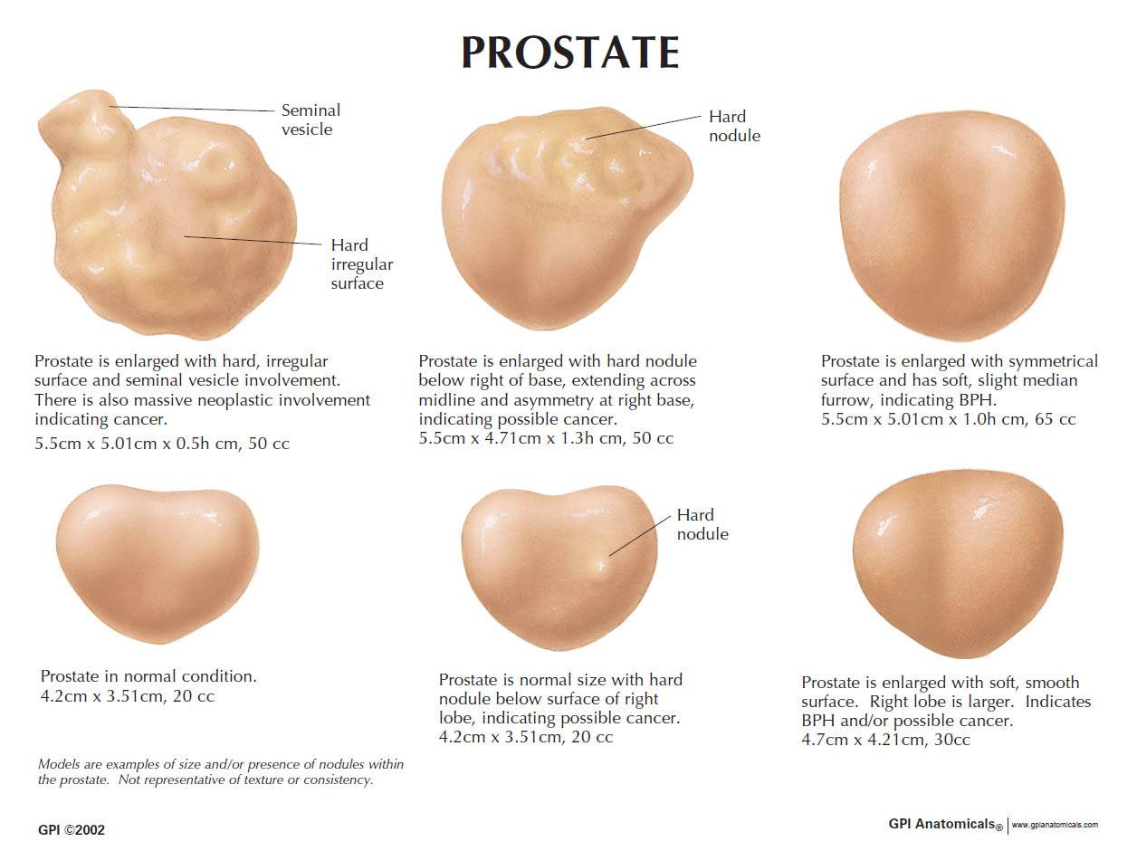 gpi-3000-life-size-prostate-model-set