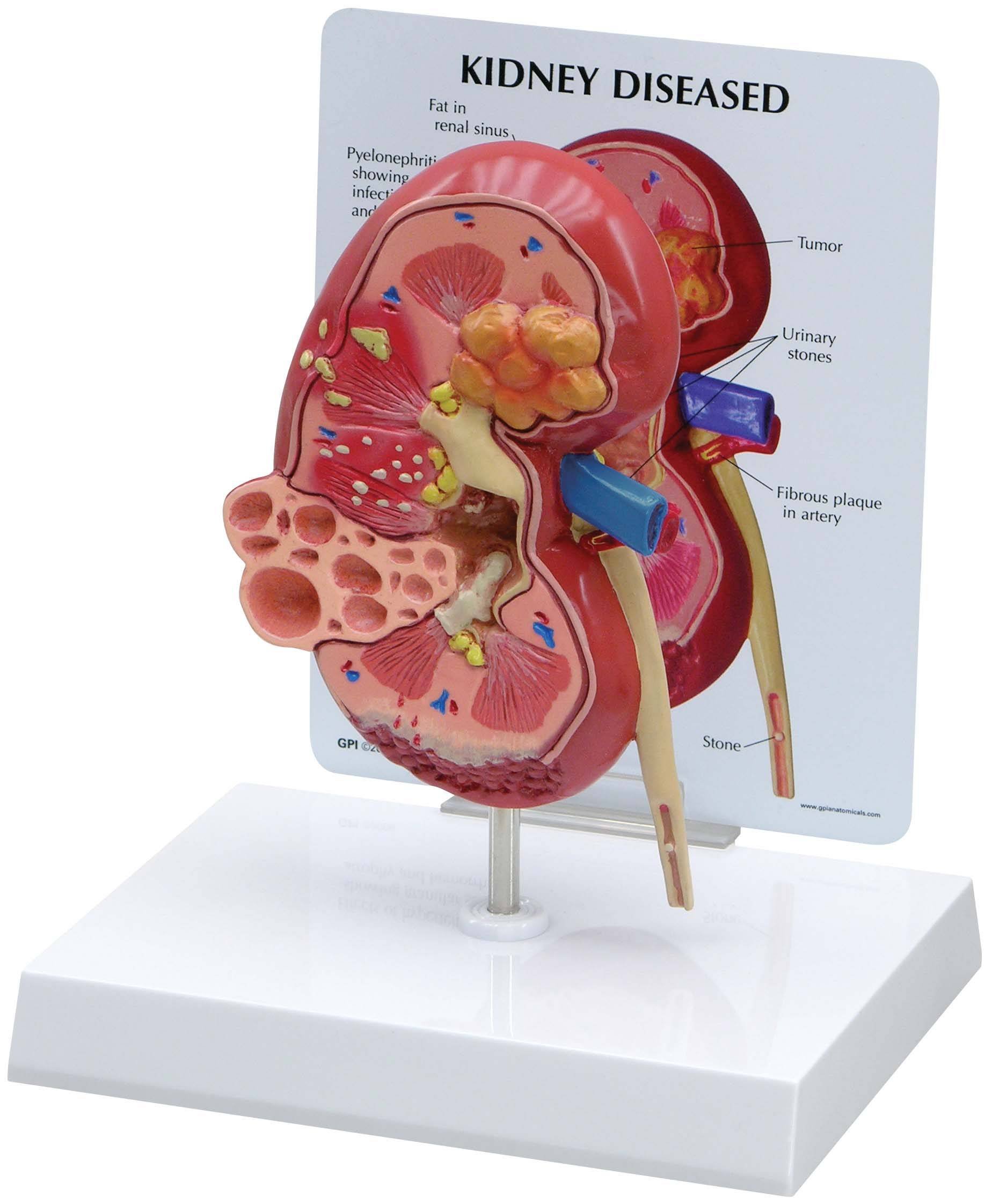 GPI 3260 Diseased Kidney