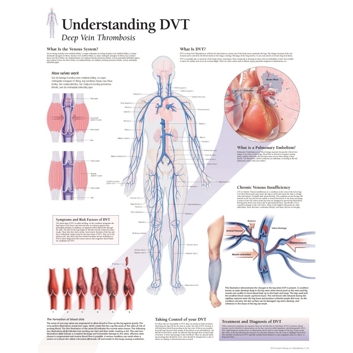https://www.universalmedicalinc.com/media/catalog/product/cache/4bef53cd5d1d72725a98f6772b6db8dd/1/6/1652_understanding-dvt-deep-vein-thrombosis-chart.jpg