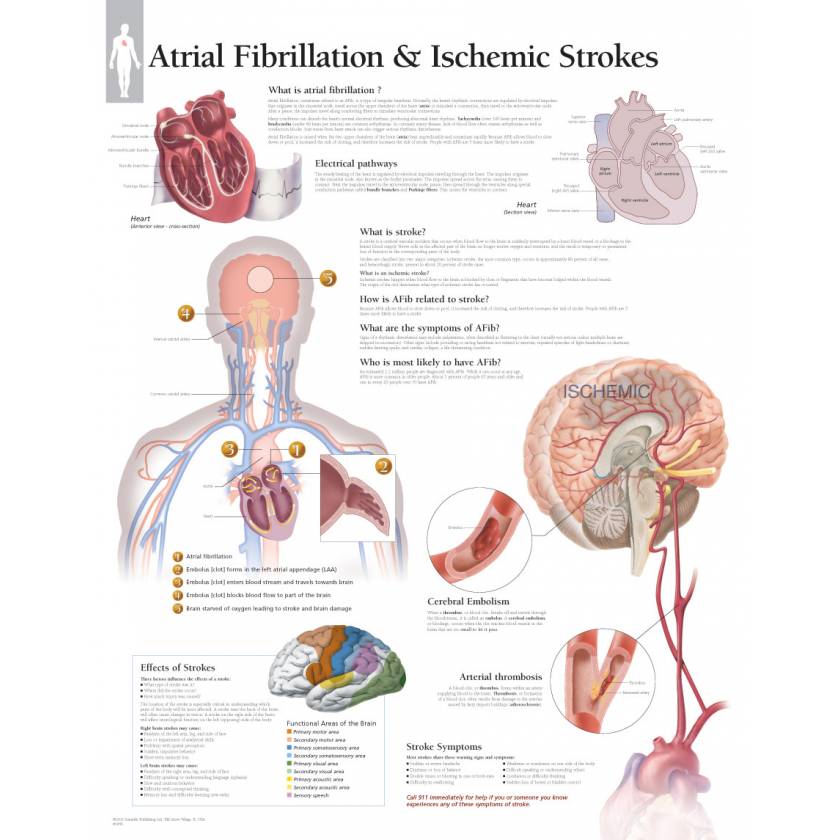 Atrial Fibrillation & Ischemic Strokes Chart