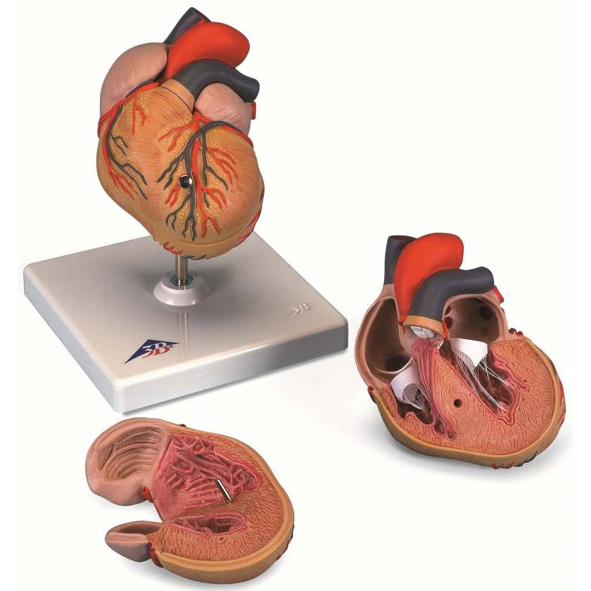 Classic Heart Model with Left Ventricular Hypertrophy (LVH) 2-Part