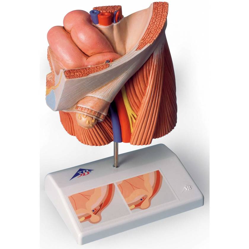 Inguinal Hernia Model