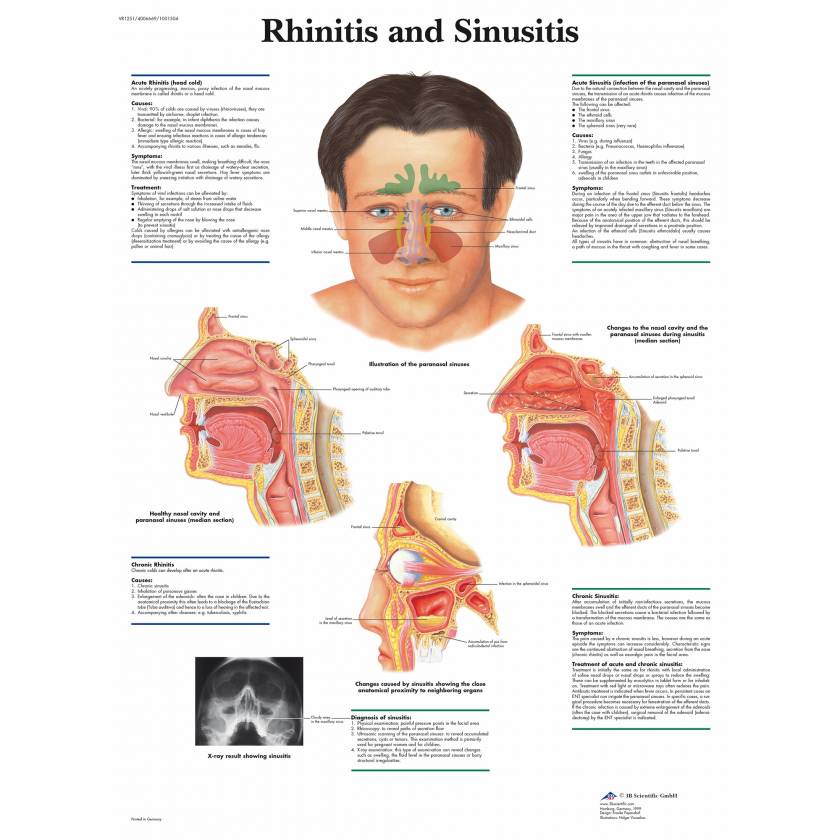 Rhinitis and Sinusitis Chart