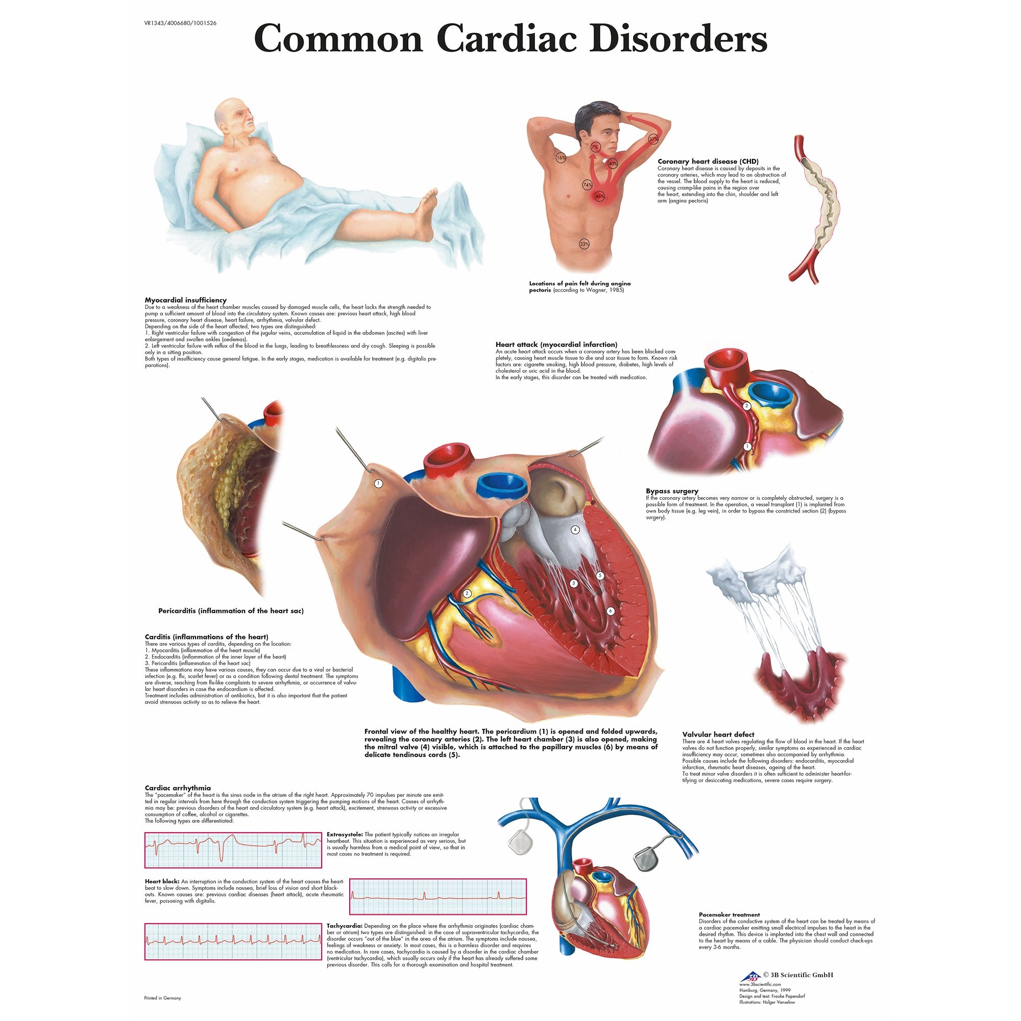 3b Scientific Common Cardiac Disorders Chart