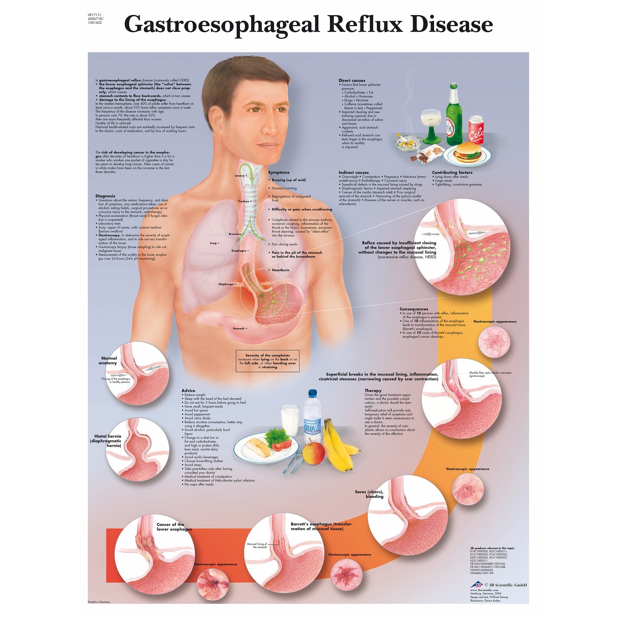 3B Scientific Gastroesophageal Reflux Disease Chart GERD 