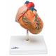 Classic Heart Model with Left Ventricular Hypertrophy (LVH) 2-Part