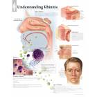 Understanding Rhinitis Chart