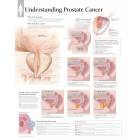 Understanding Prostate Cancer Chart
